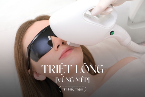 Triệt lông vùng mép